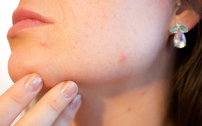 Banish Acne with out Using Drugs